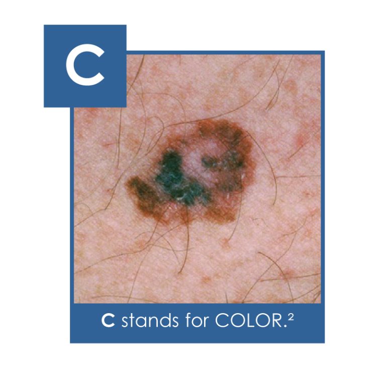 The Abcdes Of Melanoma Houston Dermatology Specialists Christopher