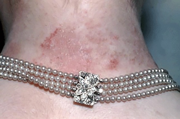 Adult with contact dermatitis on her neck